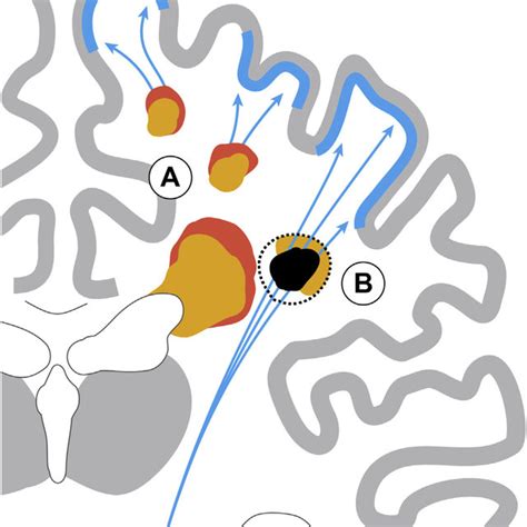 Chabriat Hugues Neurologie