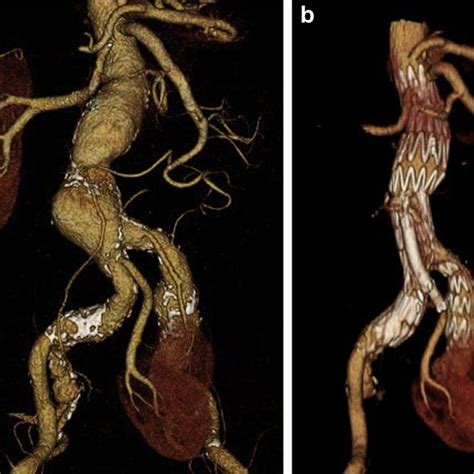 Spear Rafaelle Chirurgie vasculaire